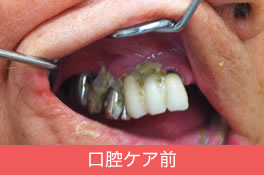 口腔ケア前