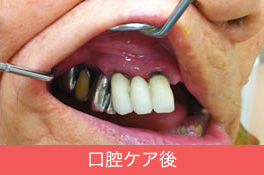 口腔ケア前